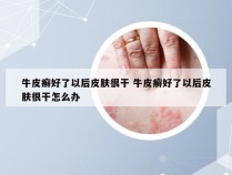 牛皮癣好了以后皮肤很干 牛皮癣好了以后皮肤很干怎么办