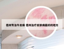 德州专治牛皮癣 德州治疗皮肤病最好的地方