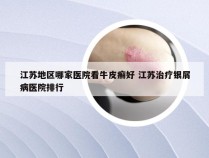 江苏地区哪家医院看牛皮癣好 江苏治疗银屑病医院排行