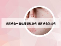 银屑病会一直往外冒红点吗 银屑病会发红吗