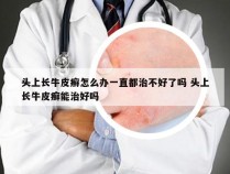 头上长牛皮癣怎么办一直都治不好了吗 头上长牛皮癣能治好吗