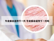 牛皮癣会遗传下一代 牛皮癣会遗传下一代吗