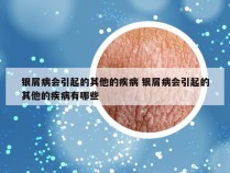 银屑病会引起的其他的疾病 银屑病会引起的其他的疾病有哪些