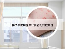 得了牛皮癣医生让自己扎针放血这