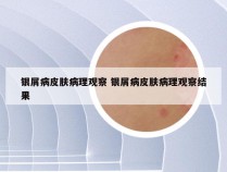 银屑病皮肤病理观察 银屑病皮肤病理观察结果