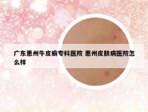 广东惠州牛皮癣专科医院 惠州皮肤病医院怎么样