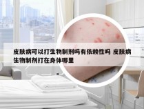 皮肤病可以打生物制剂吗有依赖性吗 皮肤病生物制剂打在身体哪里
