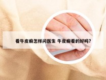 看牛皮癣怎样问医生 牛皮癣看的好吗?
