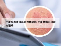 牛皮癣患者可以吃火腿肠吗 牛皮肤癣可以吃火锅吗