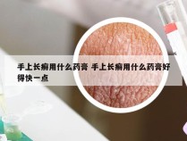 手上长癣用什么药膏 手上长癣用什么药膏好得快一点