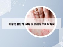 南京怎治疗牛皮癣 南京治疗牛皮癣方法