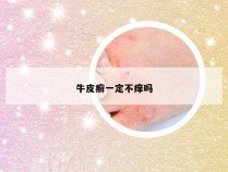 牛皮癣一定不痒吗