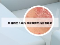 银屑病怎么涂药 银屑病擦的药膏有哪些