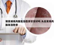 银屑病用丙酸氯倍他索软膏好吗 头皮屑用丙酸氯倍他索