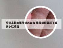 后背上长的银屑病怎么治 银屑病后背起了好多小红疙瘩