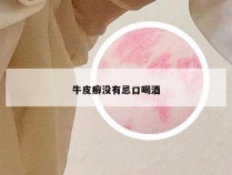 牛皮癣没有忌口喝酒