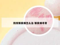 找找银屑病怎么治 银屑病寻常