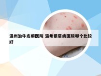 温州治牛皮癣医院 温州银屑病医院哪个比较好