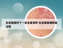 头皮银屑好了一定会复发吗 头皮银屑病恢复过程