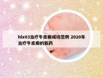 hlx03治疗牛皮癣成功范例 2020年治疗牛皮癣的新药