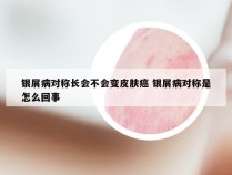 银屑病对称长会不会变皮肤癌 银屑病对称是怎么回事