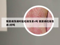 银屑病发病时能吃维生素c吗 银屑病吃维生素c好吗