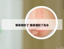 银屑病扣了 银屑病扣了出水
