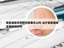 银屑病用生物制剂需要忌口吗 治疗银屑病用生物制剂好吗