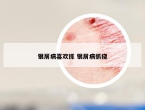 银屑病喜欢抓 银屑病抓挠