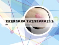宝宝遗传性银屑病 宝宝遗传性银屑病怎么治疗