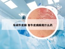车间牛皮癣 有牛皮病癣用什么药