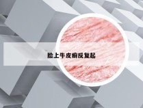 脸上牛皮癣反复起