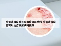 鸡蛋清加白醋可以治疗银屑病吗 鸡蛋清加白醋可以治疗银屑病吗视频