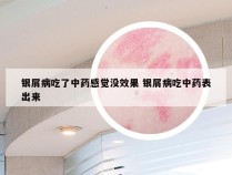 银屑病吃了中药感觉没效果 银屑病吃中药表出来