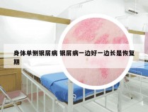 身体单侧银屑病 银屑病一边好一边长是恢复期