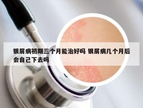 银屑病初期三个月能治好吗 银屑病几个月后会自己下去吗