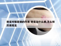 地龙对银屑病的作用 地龙治什么病,怎么样药用地龙