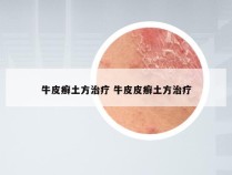 牛皮癣土方治疗 牛皮皮癣土方治疗