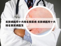 皮肤病医院十大排名银屑病 皮肤病医院十大排名银屑病医生