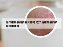 治疗银屑病的药会长胖吗 吃了治银屑病的药有啥副作用