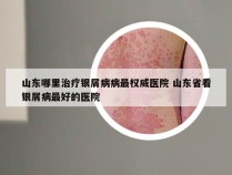 山东哪里治疗银屑病病最权威医院 山东省看银屑病最好的医院