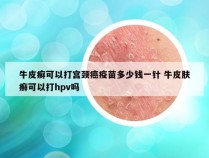 牛皮癣可以打宫颈癌疫苗多少钱一针 牛皮肤癣可以打hpv吗