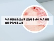 牛皮癣患者最适合生活在哪个城市 牛皮癣患者适合在哪里生活