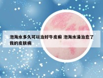 泡海水多久可以治好牛皮癣 泡海水澡治愈了我的皮肤病