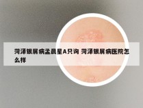 菏泽银屑病孟晨星A只询 菏泽银屑病医院怎么样