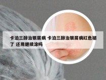 卡泊三醇治银屑病 卡泊三醇治银屑病红色褪了 还用继续涂吗