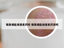 银屑病能用激素药吗 银屑病能抹激素药膏吗