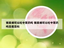 银屑病可以吃中草药吗 银屑病可以吃中草药吗百度百科