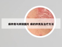 癣种类与辨别图片 癣的种类及治疗方法