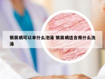 银屑病可以拿什么泡澡 银屑病适合用什么洗澡